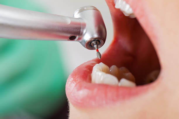 Best Emergency Tooth Extraction in Wamego, KS